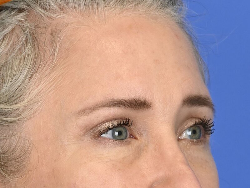 Brow Lift Before & After Image