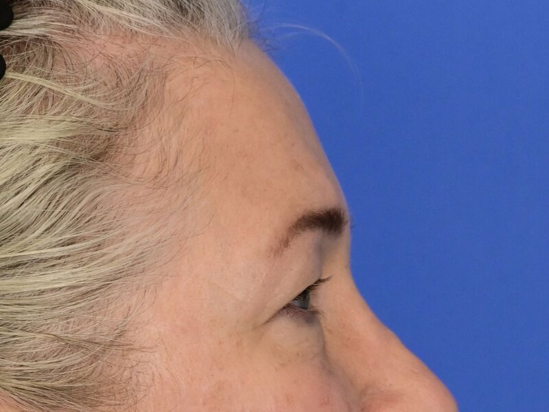 Brow Lift Before & After Image
