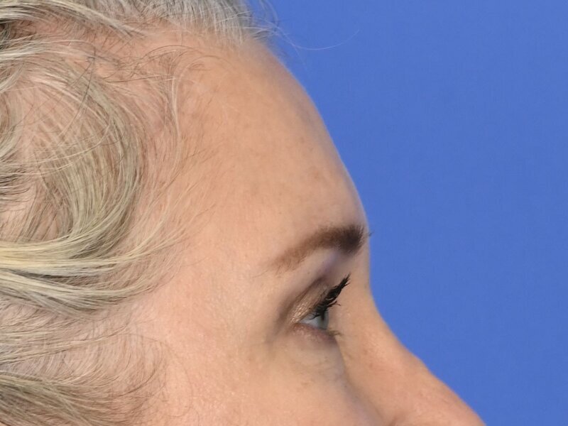 Brow Lift Before & After Image