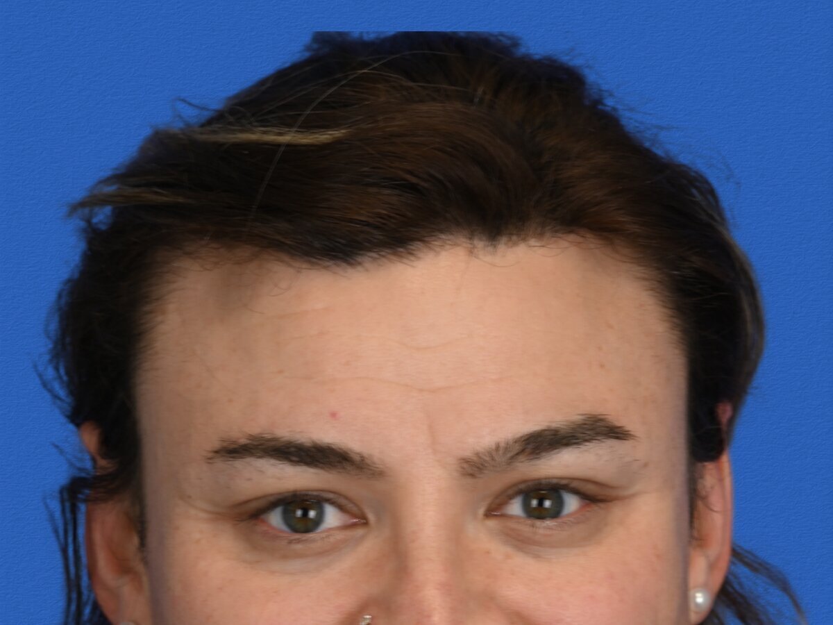 Brow Lift Before & After Image
