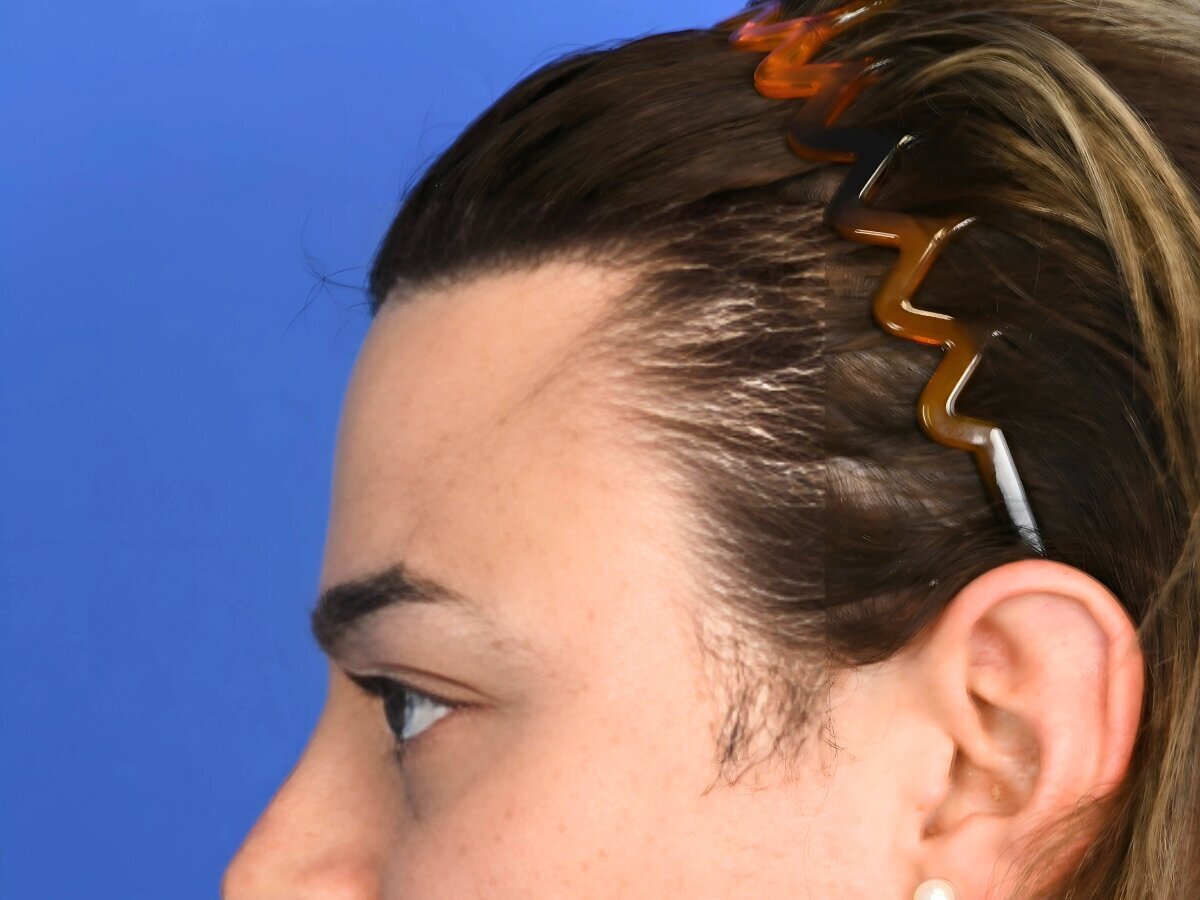 Brow Lift Before & After Image