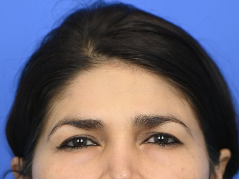 Brow Lift Before & After Image