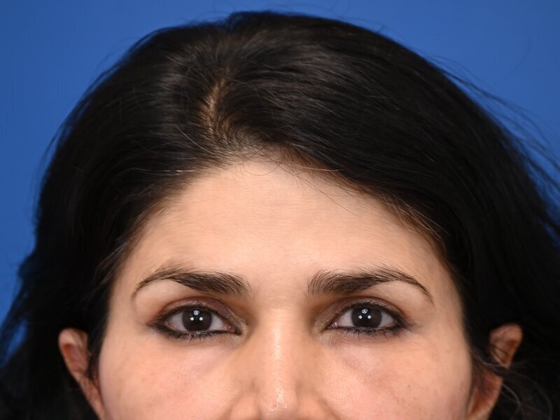 Brow Lift Before & After Image