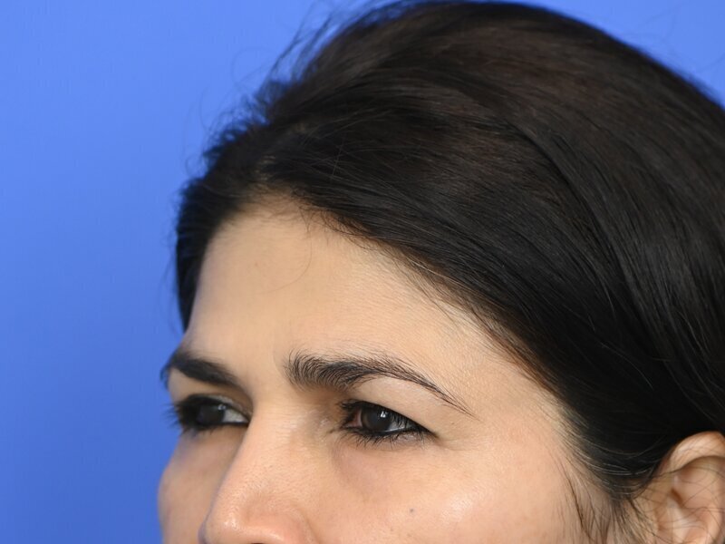 Brow Lift Before & After Image