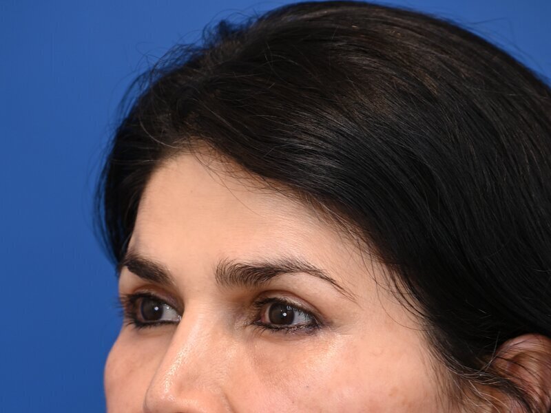 Brow Lift Before & After Image