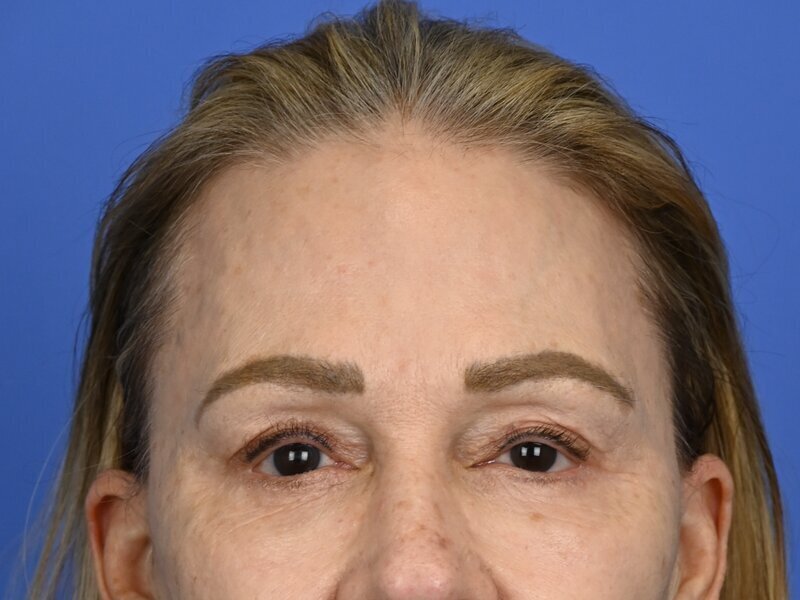 Brow Lift Before & After Image