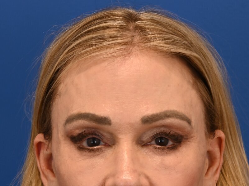 Brow Lift Before & After Image