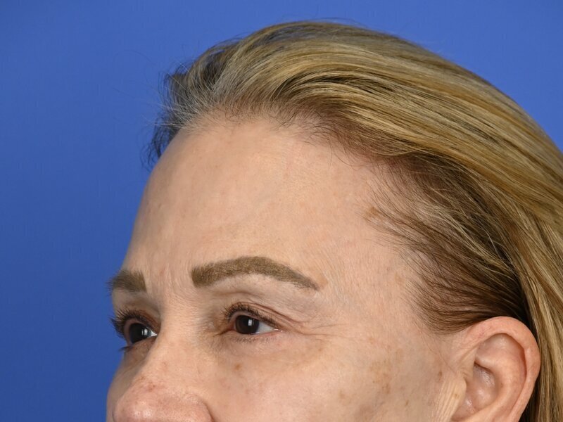 Brow Lift Before & After Image