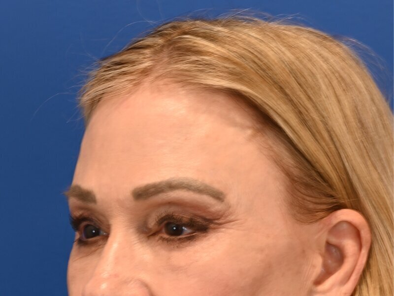 Brow Lift Before & After Image