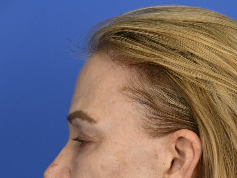 Brow Lift Before & After Image