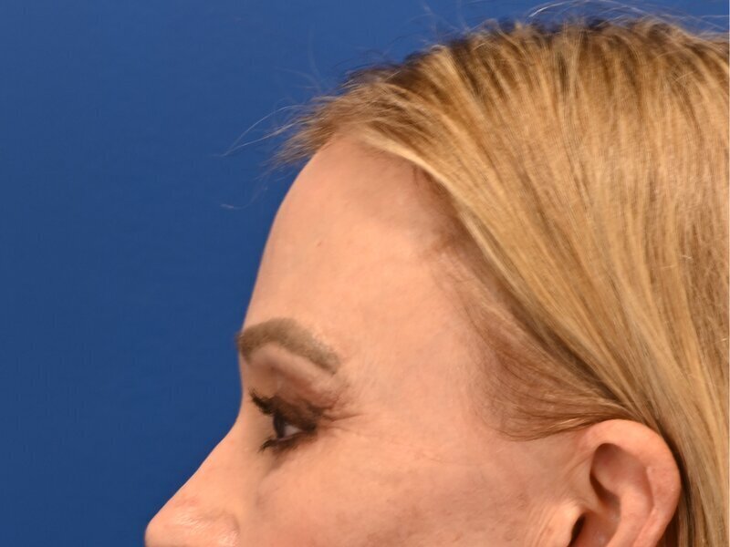 Brow Lift Before & After Image