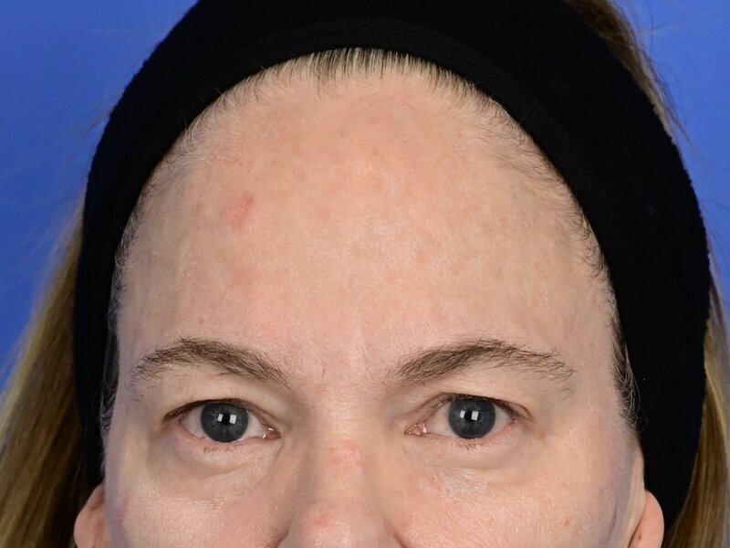 Brow Lift Before & After Image