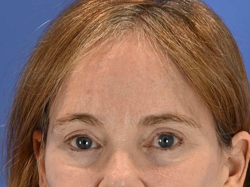 Brow Lift Before & After Image