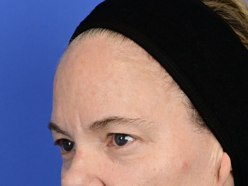 Brow Lift Before & After Image