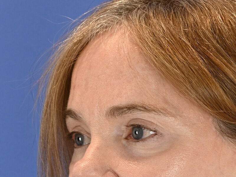Brow Lift Before & After Image