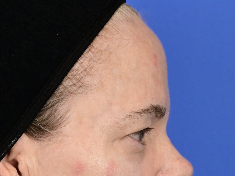 Brow Lift Before & After Image