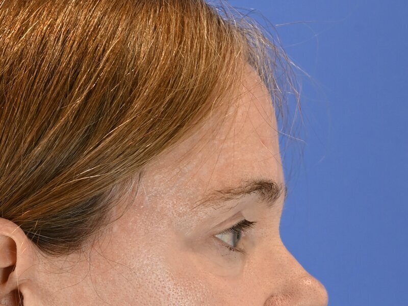 Brow Lift Before & After Image