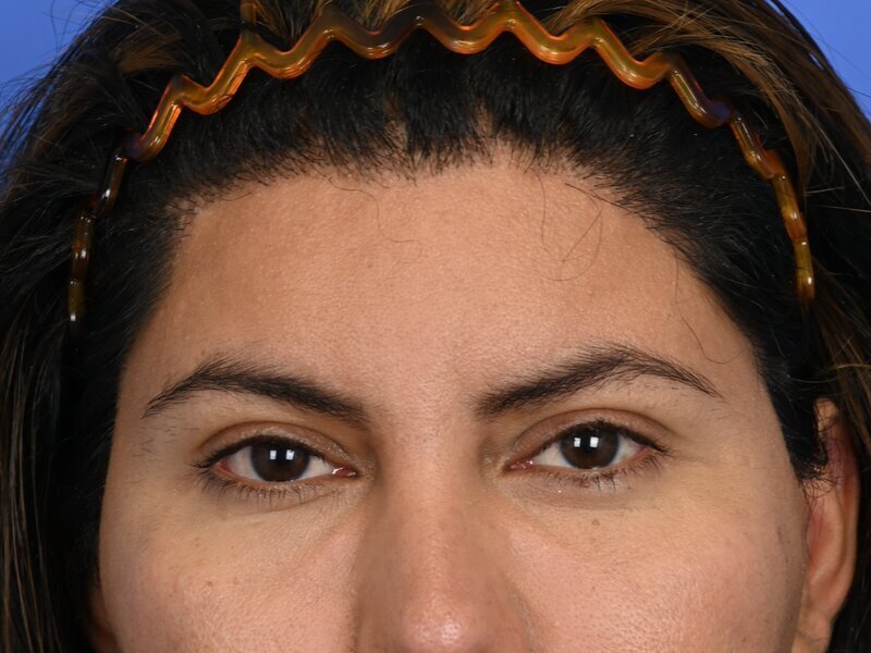 Brow Lift Before & After Image