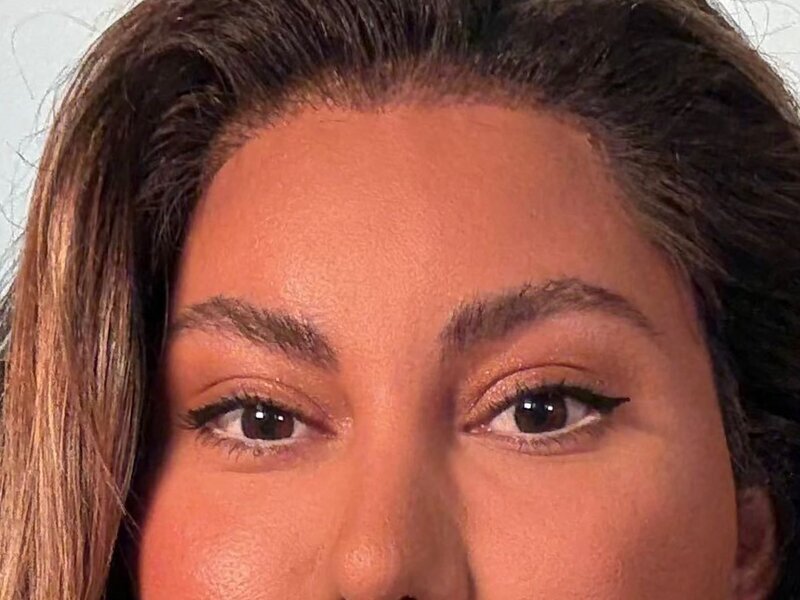Brow Lift Before & After Image