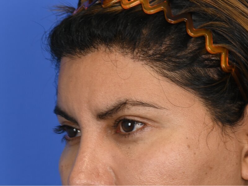 Brow Lift Before & After Image