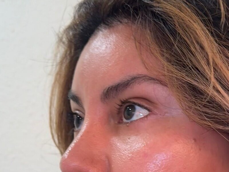 Brow Lift Before & After Image