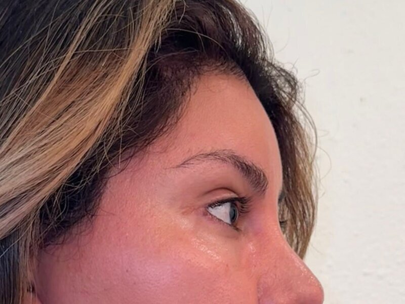 Brow Lift Before & After Image