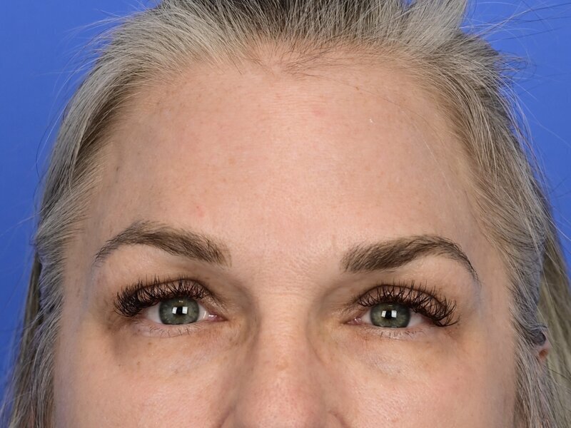 Brow Lift Before & After Image
