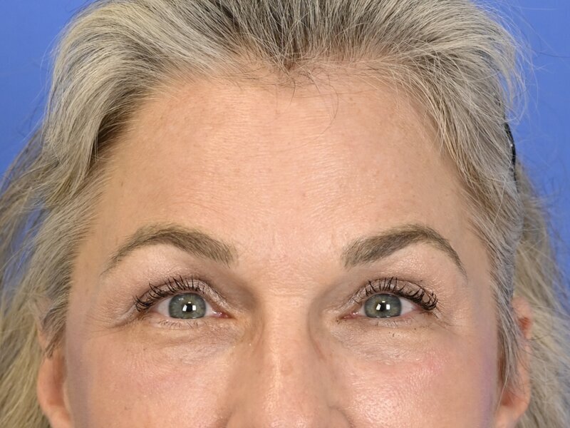 Brow Lift Before & After Image