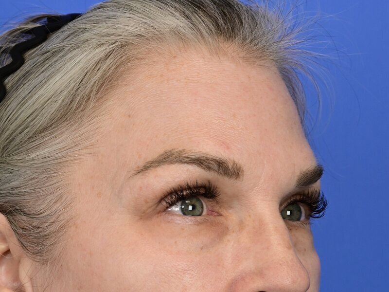Brow Lift Before & After Image