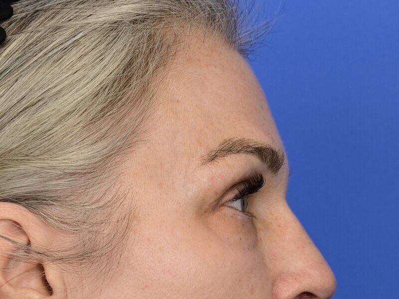 Brow Lift Before & After Image