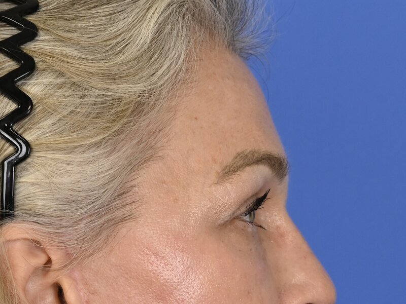 Brow Lift Before & After Image