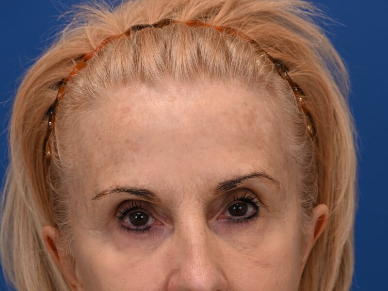 Brow Lift Before & After Image
