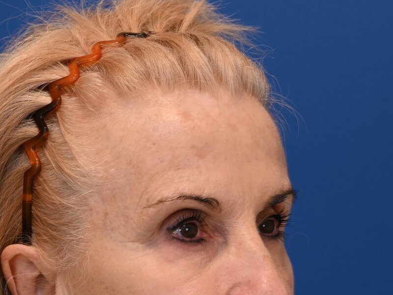 Brow Lift Before & After Image