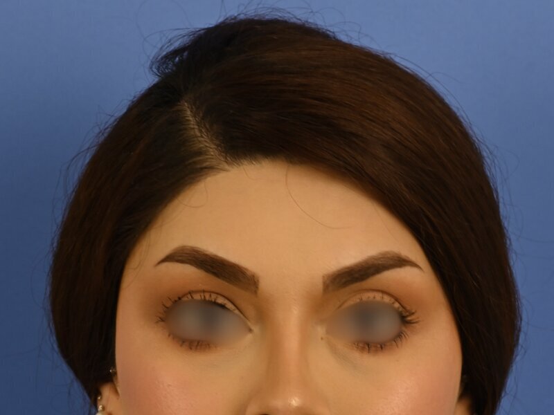 Brow Lift Before & After Image