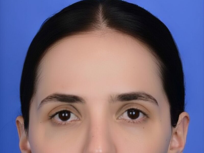 Brow Lift Before & After Image