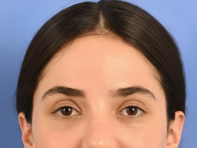 Brow Lift Before & After Image