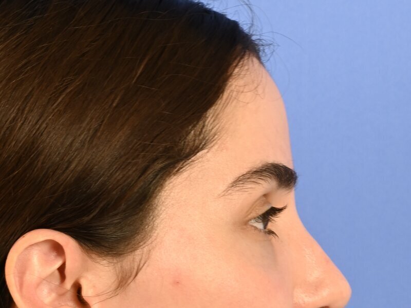 Brow Lift Before & After Image
