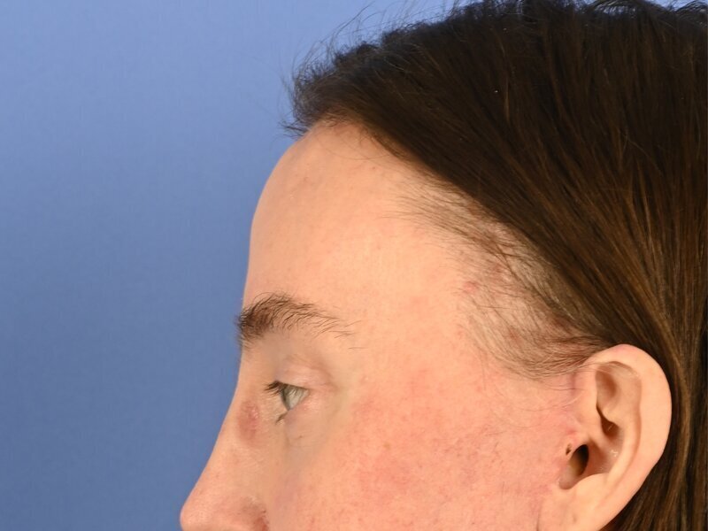 Brow Lift Before & After Image