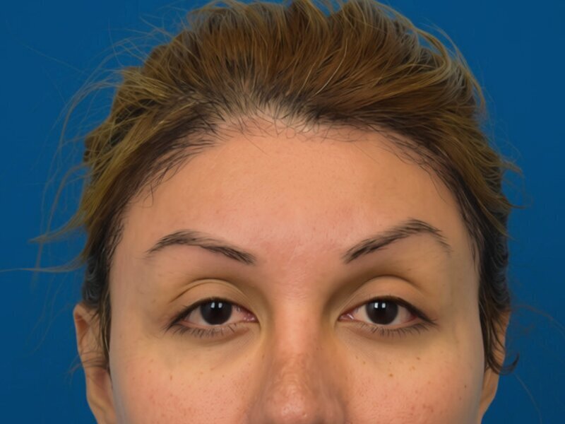 Brow Lift Before & After Image