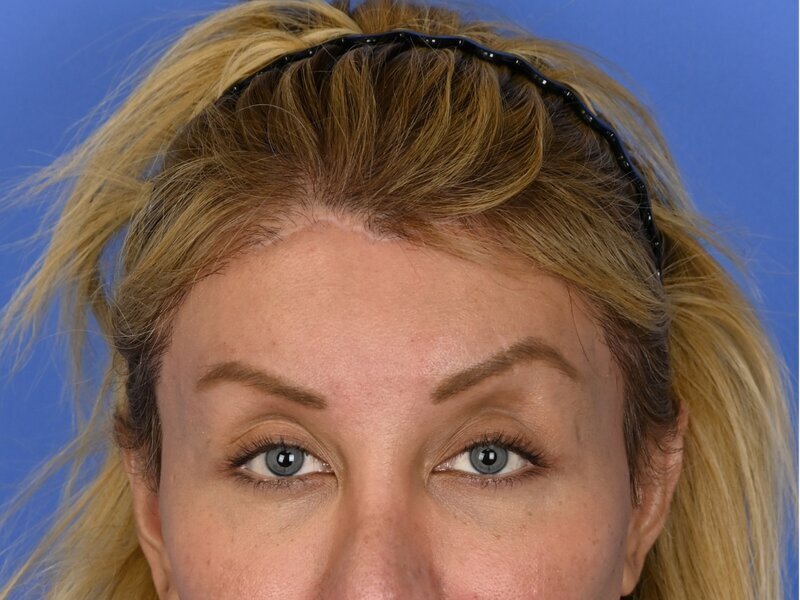 Brow Lift Before & After Image