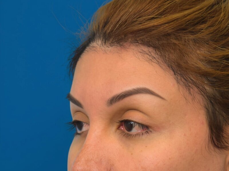 Brow Lift Before & After Image