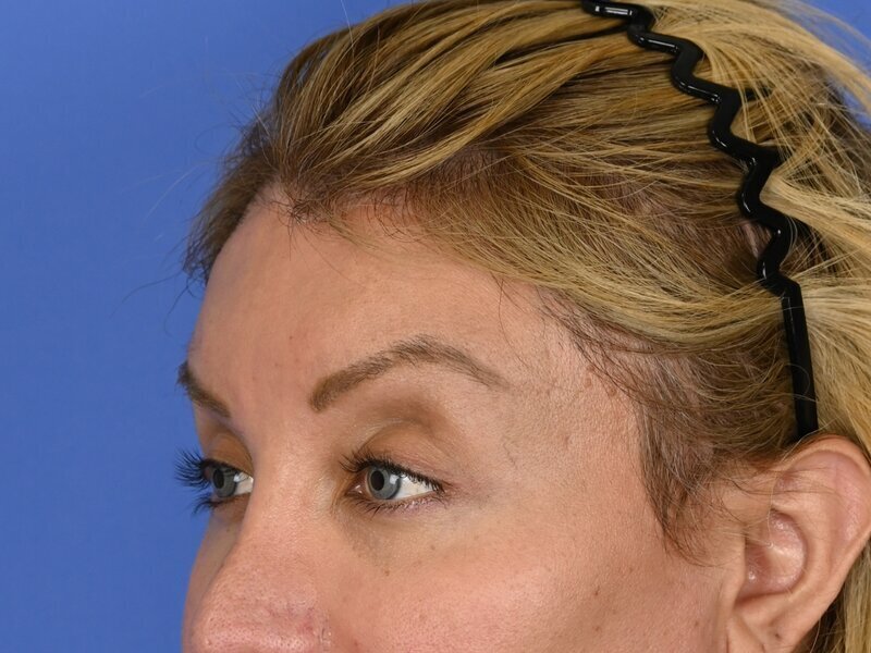 Brow Lift Before & After Image