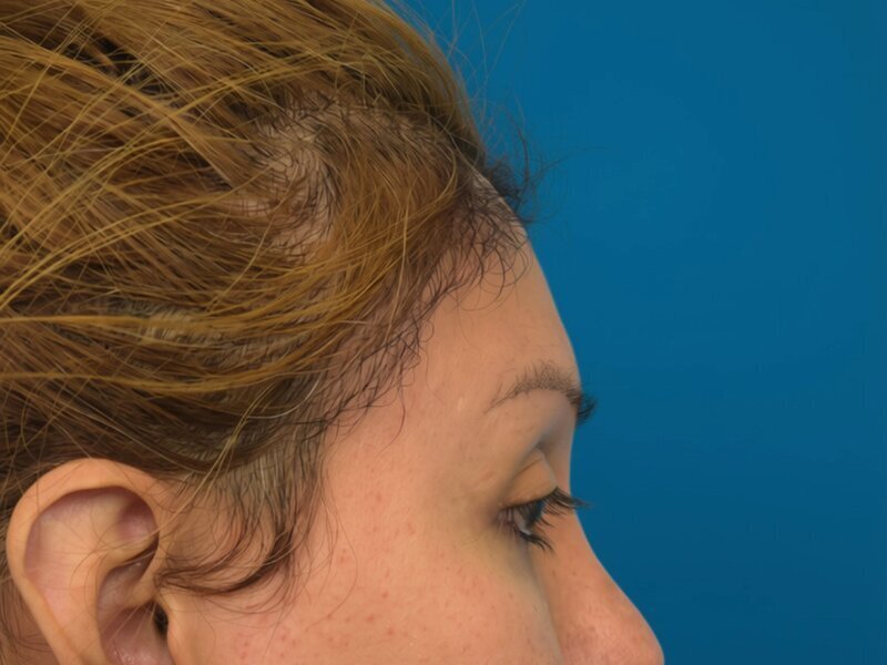 Brow Lift Before & After Image