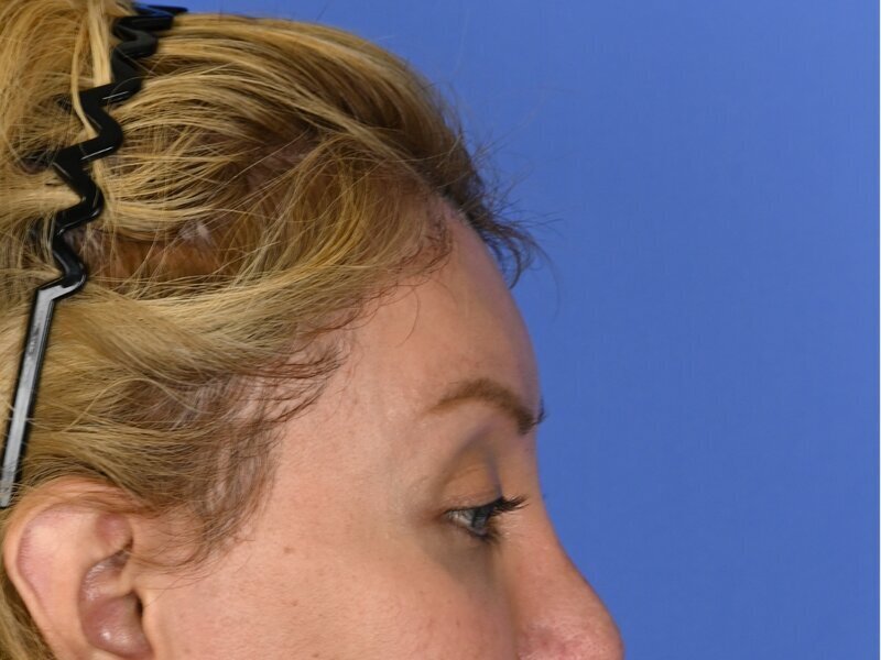 Brow Lift Before & After Image
