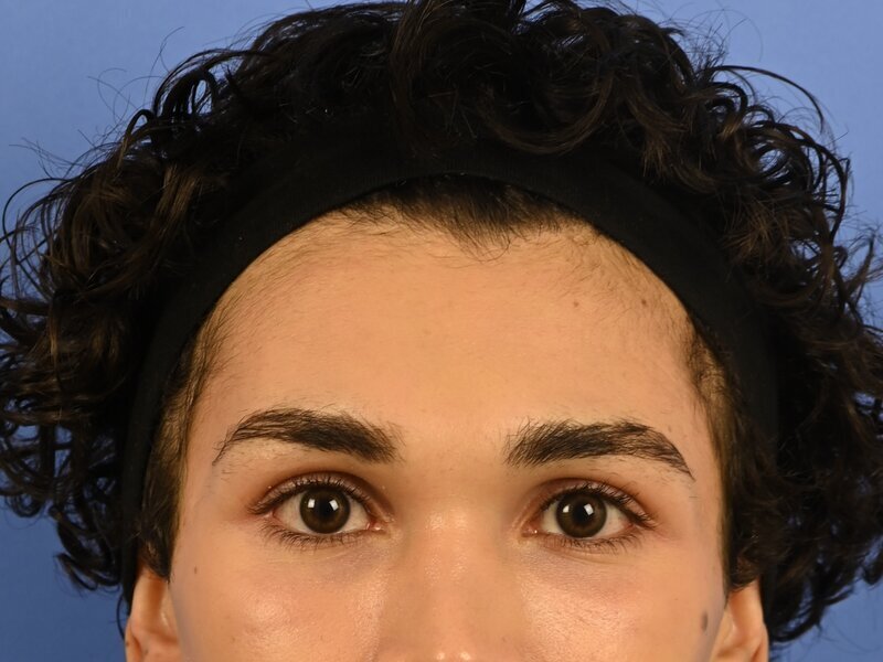 Brow Lift Before & After Image