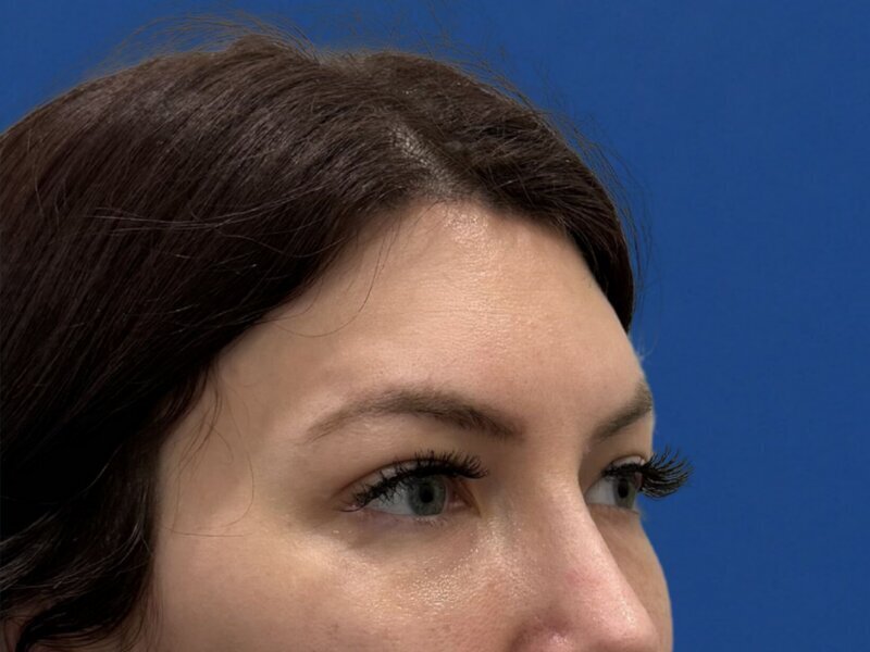Brow Lift Before & After Image