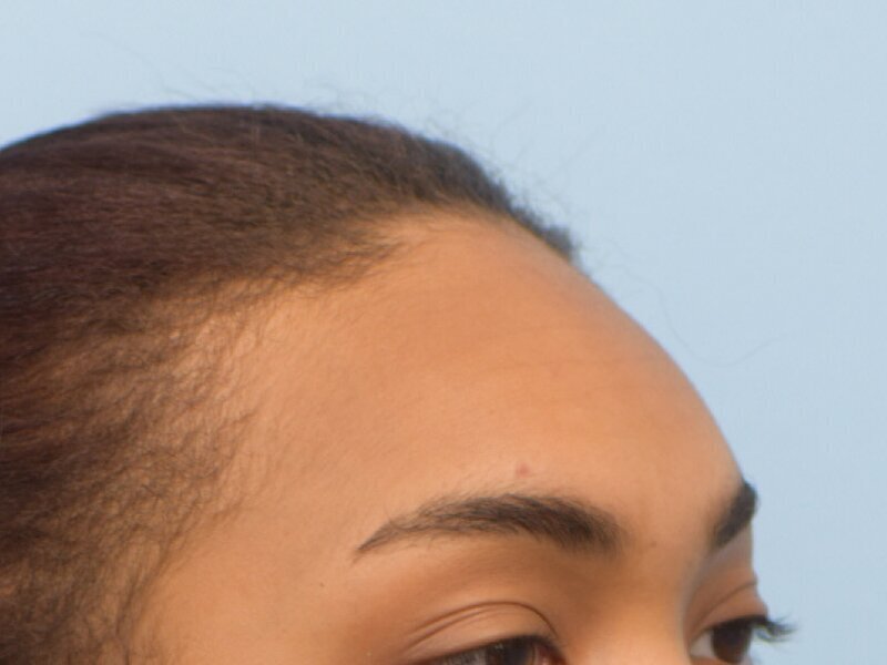 Hair Grafting Before & After Image