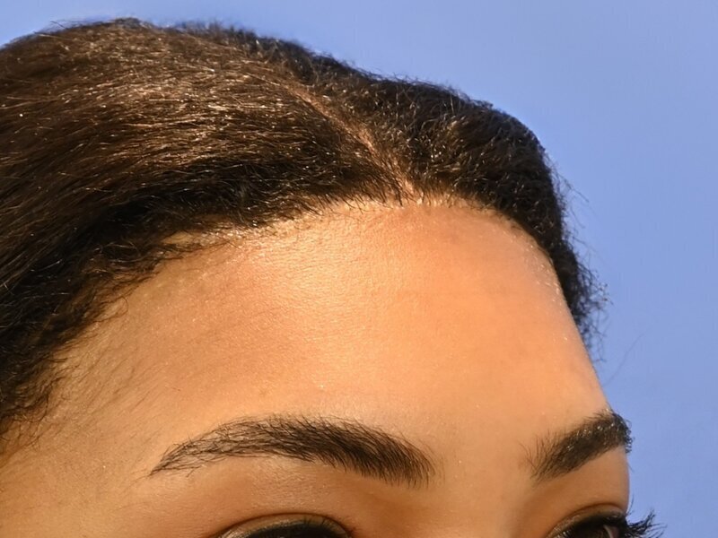 Hair Grafting Before & After Image