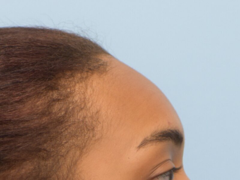 Hair Grafting Before & After Image