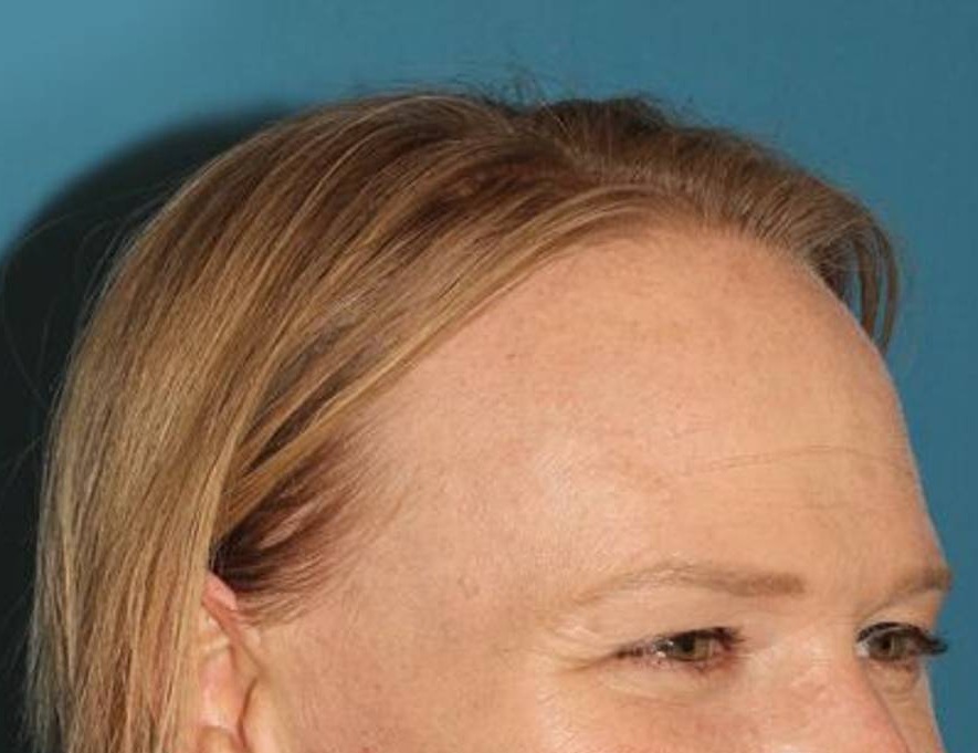 Hairline Advancement Before & After Image